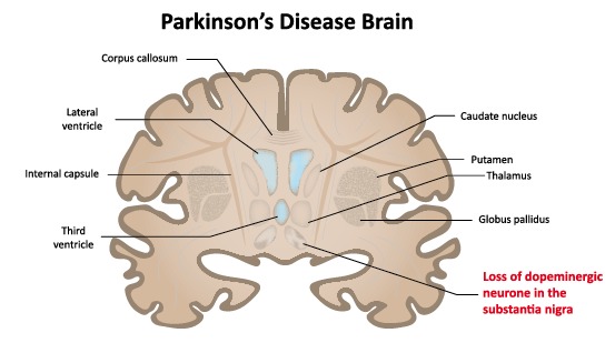 Nicotine Parkinson's disease